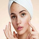 این مواد غذایی را بخورید تا جوش نزنید