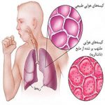 ذات الریه یا سینه پهلو چیست؟