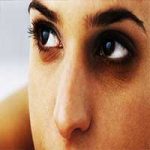محلول رفع کبودی دور چشم
