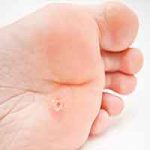 زگیل چیست؟ آیا درمان می شود؟